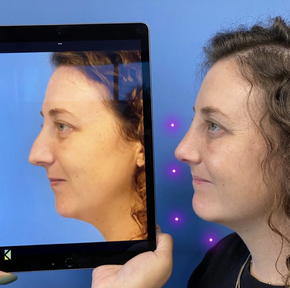 Chin Augmentation Before & After Gallery - Patient 393467 - Image 1