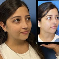 Rhinoplasty Before & After Gallery - Patient 397233 - Image 1