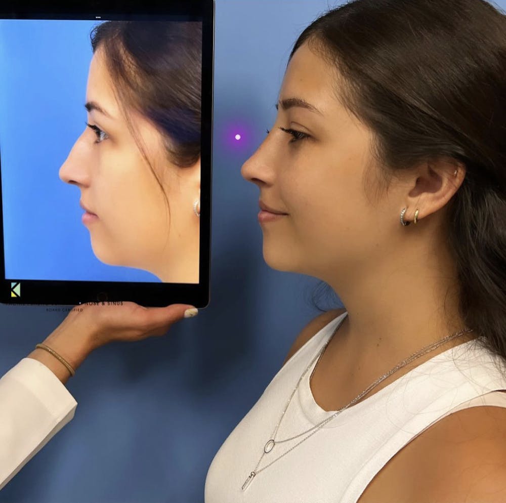 Rhinoplasty Before & After Gallery - Patient 397233 - Image 2