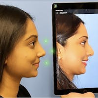 Rhinoplasty Before & After Gallery - Patient 271821 - Image 1
