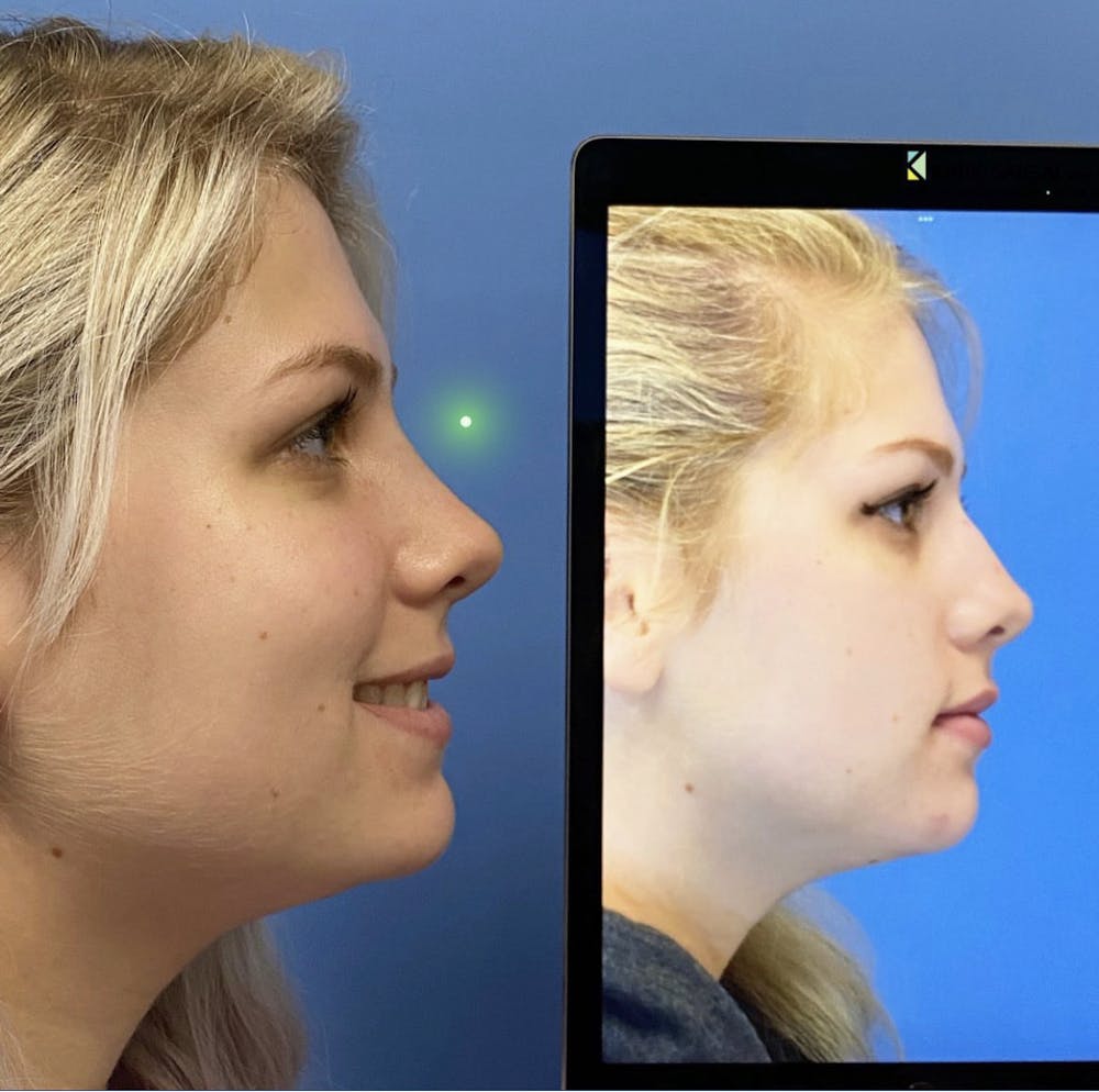 Rhinoplasty Before & After Gallery - Patient 416140 - Image 1