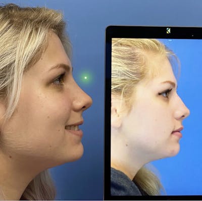 Rhinoplasty Before & After Gallery - Patient 416140 - Image 1