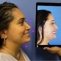 Chin Augmentation Before & After Gallery - Patient 237746 - Image 1