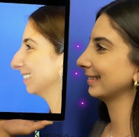 Chin Augmentation Before & After Gallery - Patient 366179 - Image 1