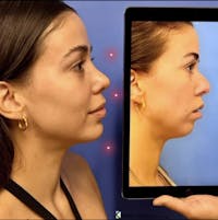 Chin Augmentation Before & After Gallery - Patient 208065 - Image 1