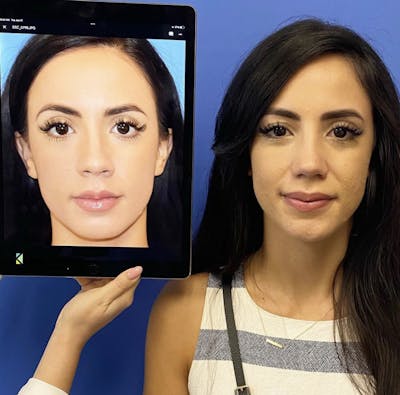 Rhinoplasty Before & After Gallery - Patient 317486 - Image 2