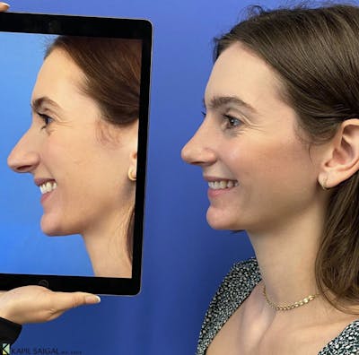 Rhinoplasty Before & After Gallery - Patient 361017 - Image 1