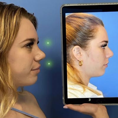 Rhinoplasty Before & After Gallery - Patient 376049 - Image 1