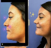Rhinoplasty Before & After Gallery - Patient 346891 - Image 1