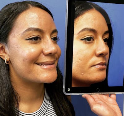 Rhinoplasty Before & After Gallery - Patient 346891 - Image 2