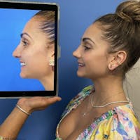 Rhinoplasty Before & After Gallery - Patient 342943 - Image 1