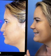 Rhinoplasty Before & After Gallery - Patient 517484 - Image 1