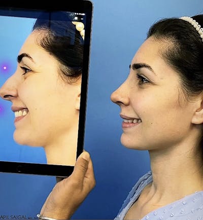 Rhinoplasty Before & After Gallery - Patient 825913 - Image 1