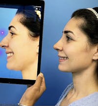 Rhinoplasty Before & After Gallery - Patient 825913 - Image 1