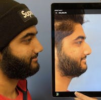 Rhinoplasty Before & After Gallery - Patient 204774 - Image 1