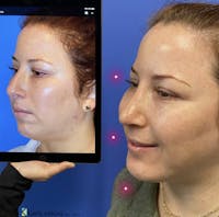 Chin Augmentation Before & After Gallery - Patient 154220 - Image 1