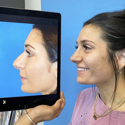 Rhinoplasty Before & After Gallery - Patient 315110 - Image 1