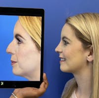 Rhinoplasty Before & After Gallery - Patient 288318 - Image 1