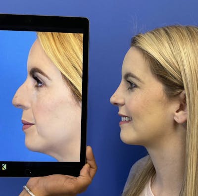 Rhinoplasty Before & After Gallery - Patient 288318 - Image 1
