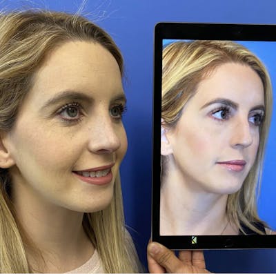 Rhinoplasty Before & After Gallery - Patient 365315 - Image 1