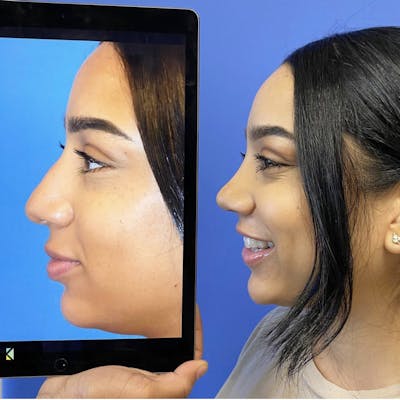Rhinoplasty Before & After Gallery - Patient 299978 - Image 1