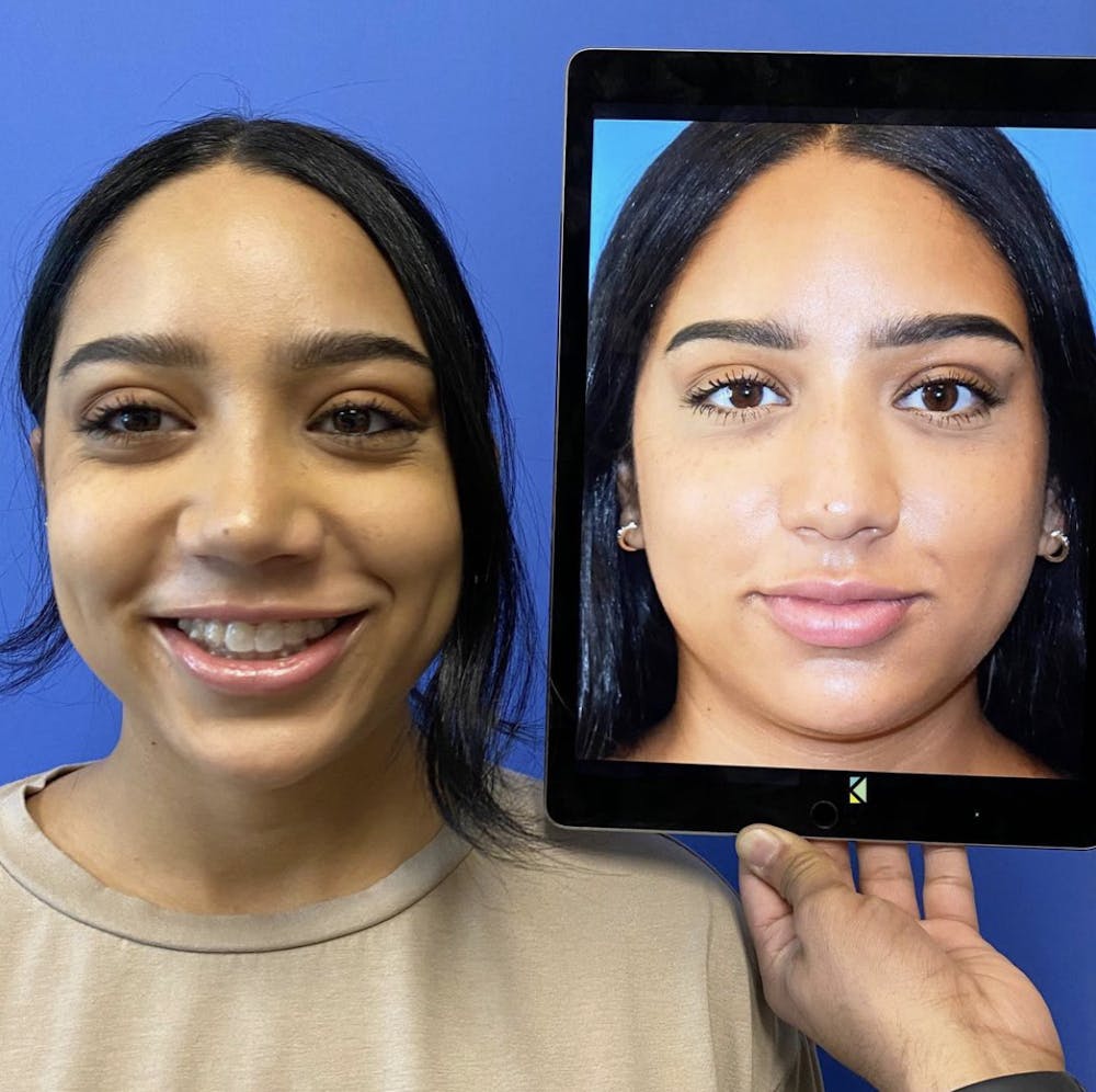 Rhinoplasty Before & After Gallery - Patient 299978 - Image 3