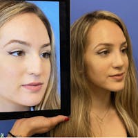 Rhinoplasty Before & After Gallery - Patient 114985 - Image 1