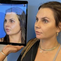 Rhinoplasty Before & After Gallery - Patient 219750 - Image 1