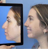 Rhinoplasty Before & After Gallery - Patient 226873 - Image 1
