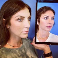 Rhinoplasty Before & After Gallery - Patient 126474 - Image 1