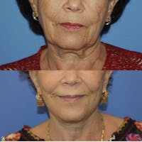 Facelift & Neck Lift Before & After Gallery - Patient 184840 - Image 1