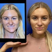 Rhinoplasty Before & After Gallery - Patient 236598 - Image 1