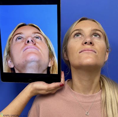 Rhinoplasty Before & After Gallery - Patient 236598 - Image 2