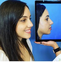 Rhinoplasty Before & After Gallery - Patient 813558 - Image 1