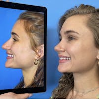 Rhinoplasty Before & After Gallery - Patient 356124 - Image 1