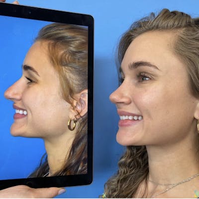 Rhinoplasty Before & After Gallery - Patient 356124 - Image 1