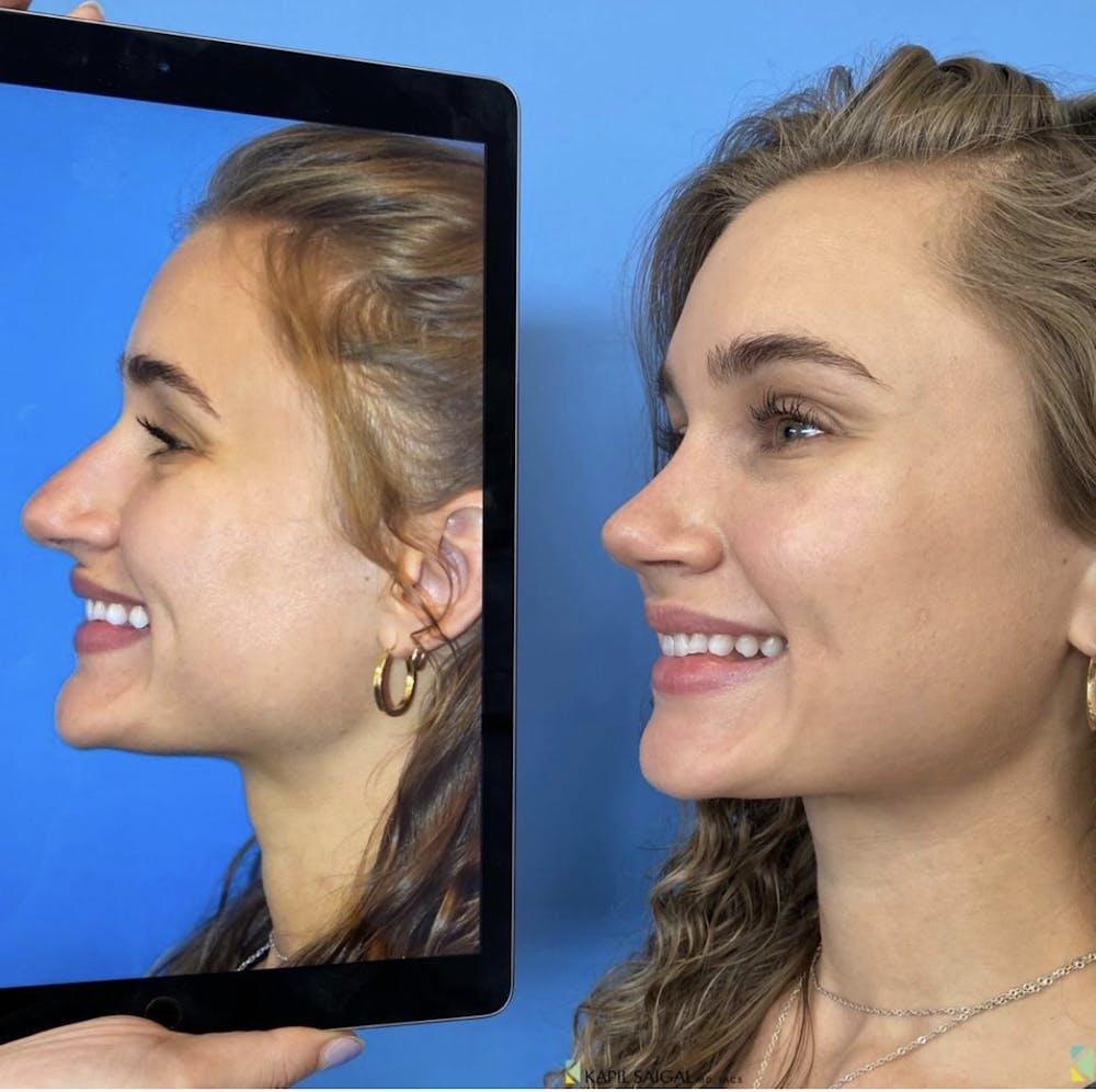 Rhinoplasty Before & After Gallery - Patient 356124 - Image 1