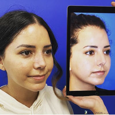 Rhinoplasty Before & After Gallery - Patient 166070 - Image 1