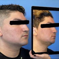 Rhinoplasty Before & After Gallery - Patient 779348 - Image 1