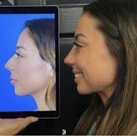 Rhinoplasty Before & After Gallery - Patient 722182 - Image 1