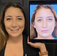 Rhinoplasty Before & After Gallery - Patient 170271 - Image 1