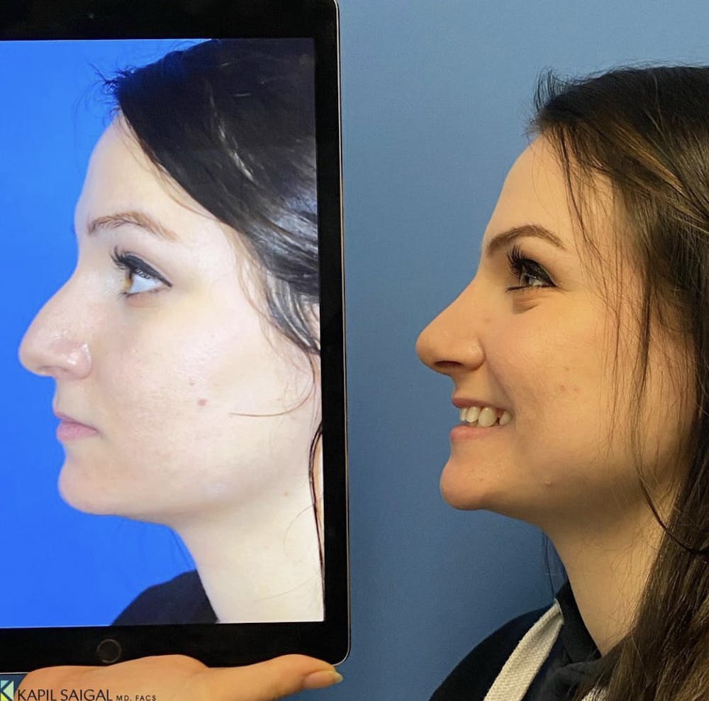 Rhinoplasty Before & After Gallery - Patient 305550 - Image 1