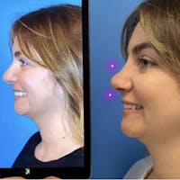 Rhinoplasty Before & After Gallery - Patient 130475 - Image 1