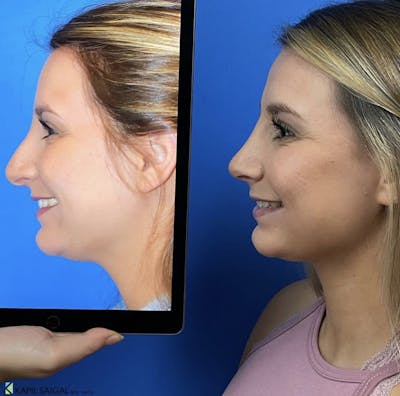 Rhinoplasty Before & After Gallery - Patient 668810 - Image 1