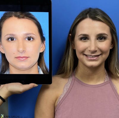 Rhinoplasty Before & After Gallery - Patient 668810 - Image 2