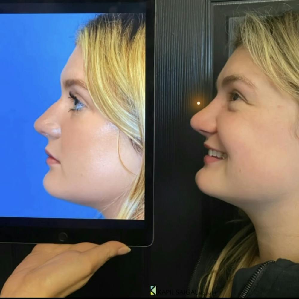 Rhinoplasty Before & After Gallery - Patient 293302 - Image 1