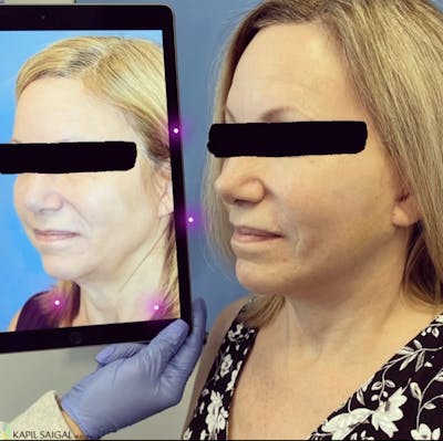 Facelift & Neck Lift Before & After Gallery - Patient 214587 - Image 1