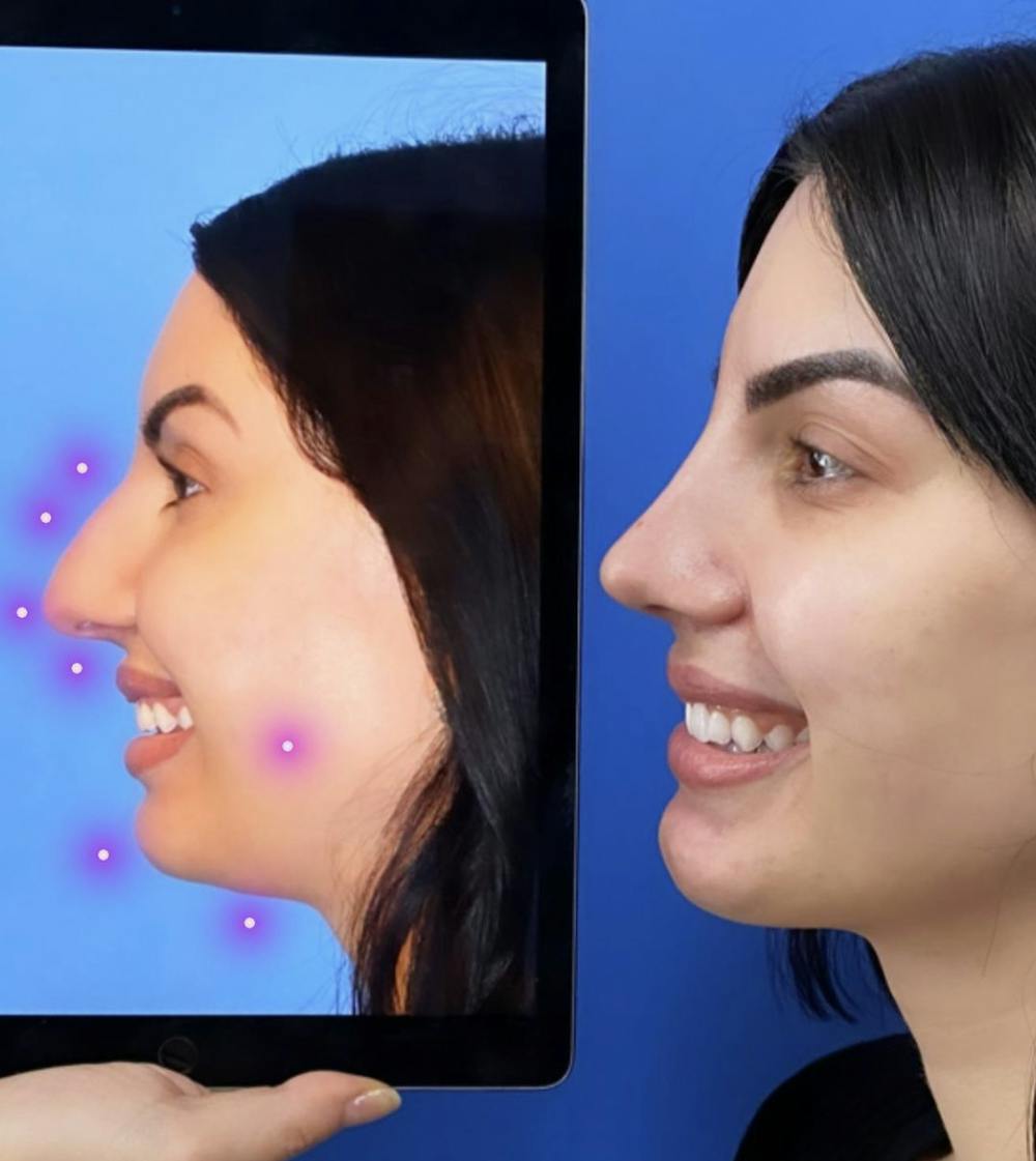 Chin Augmentation Before & After Gallery - Patient 147016 - Image 1