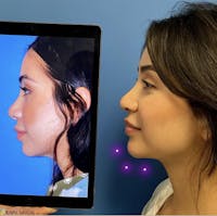 Chin Augmentation Before & After Gallery - Patient 149990 - Image 1