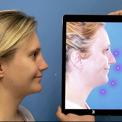 Chin Augmentation Before & After Gallery - Patient 124181 - Image 1